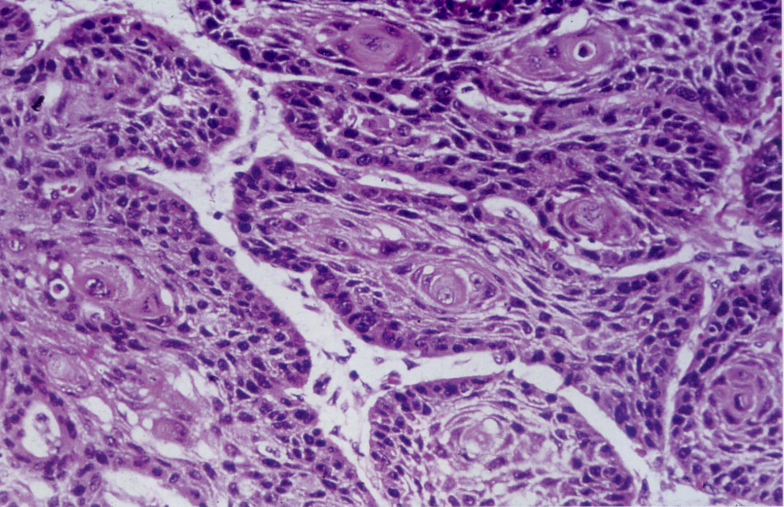 Squamous cell carcinoma of the lung