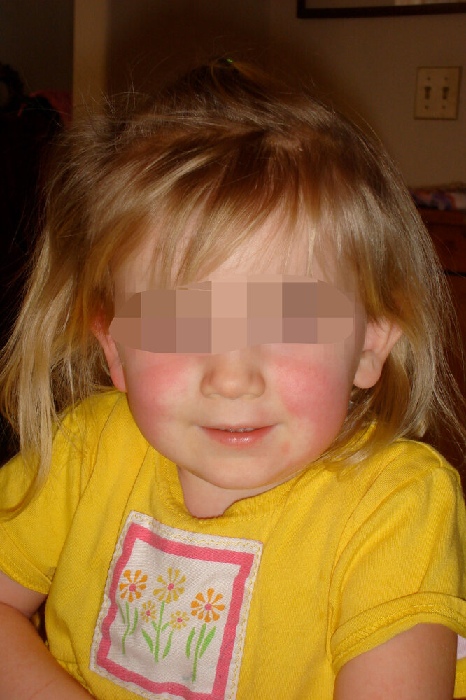 Perioral pallor in scarlet fever