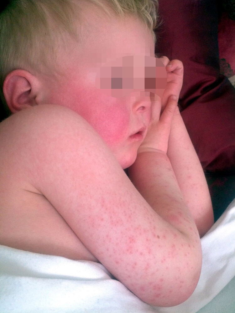 Skin manifestations in scarlet fever