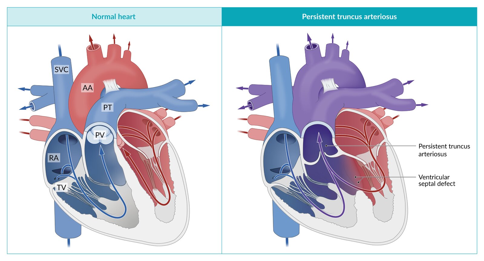 Persistent truncus arteriosus