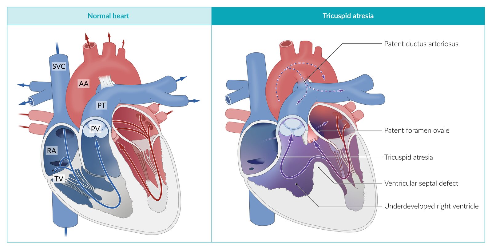 Tricuspid valve atresia