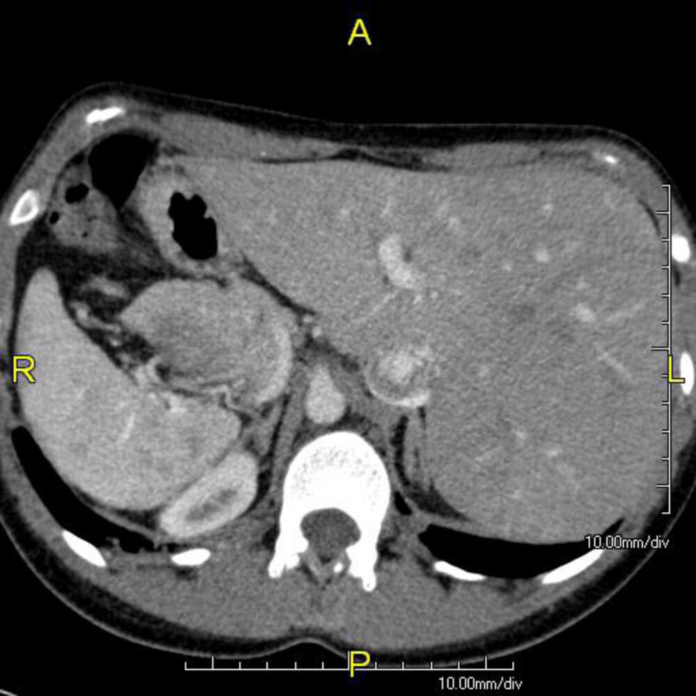 Situs inversus due to Kartagener syndrome