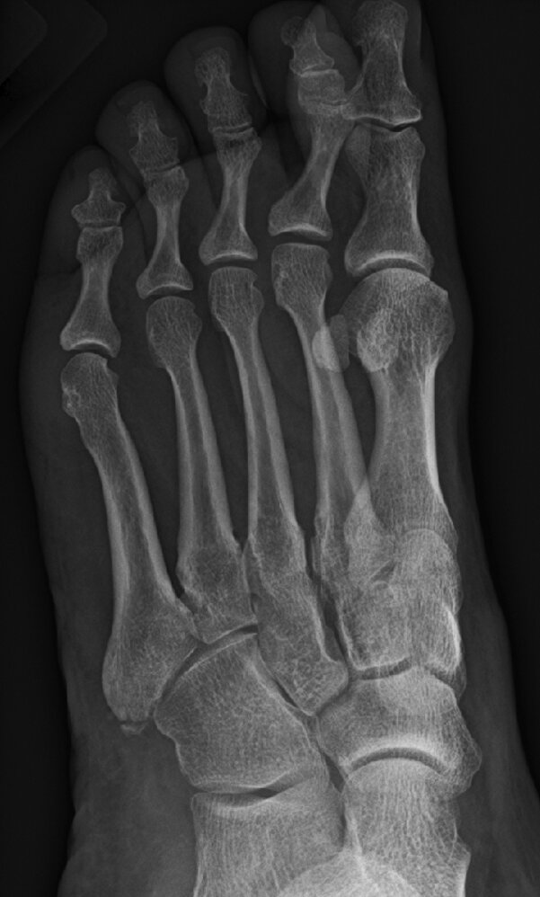 Avulsion fracture of the 5ᵗʰ metatarsal base