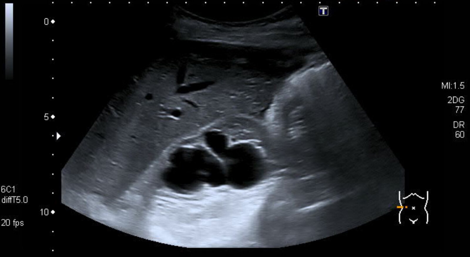 Hydronephrosis (grade 4)