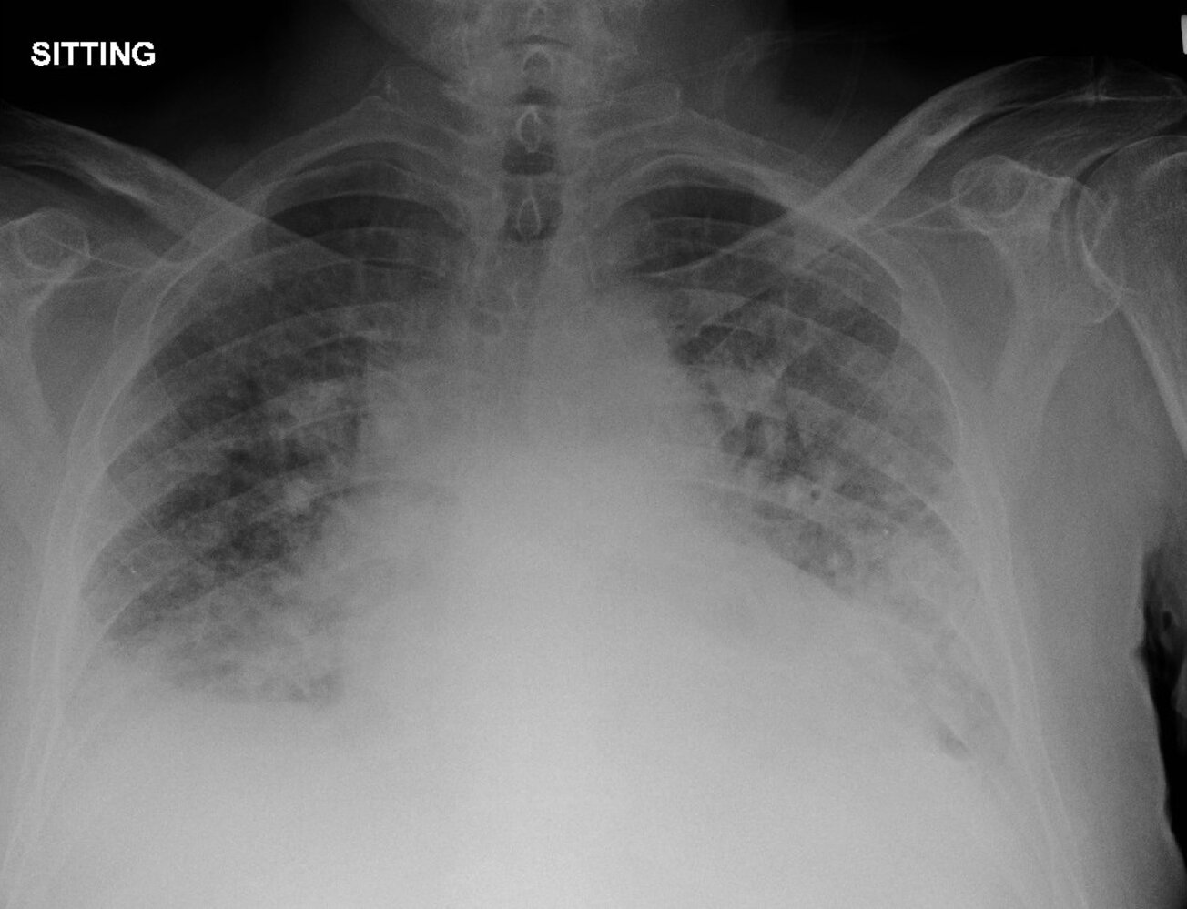 Cardiogenic pulmonary edema