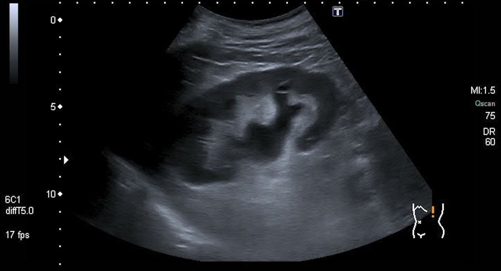 Hydronephrosis