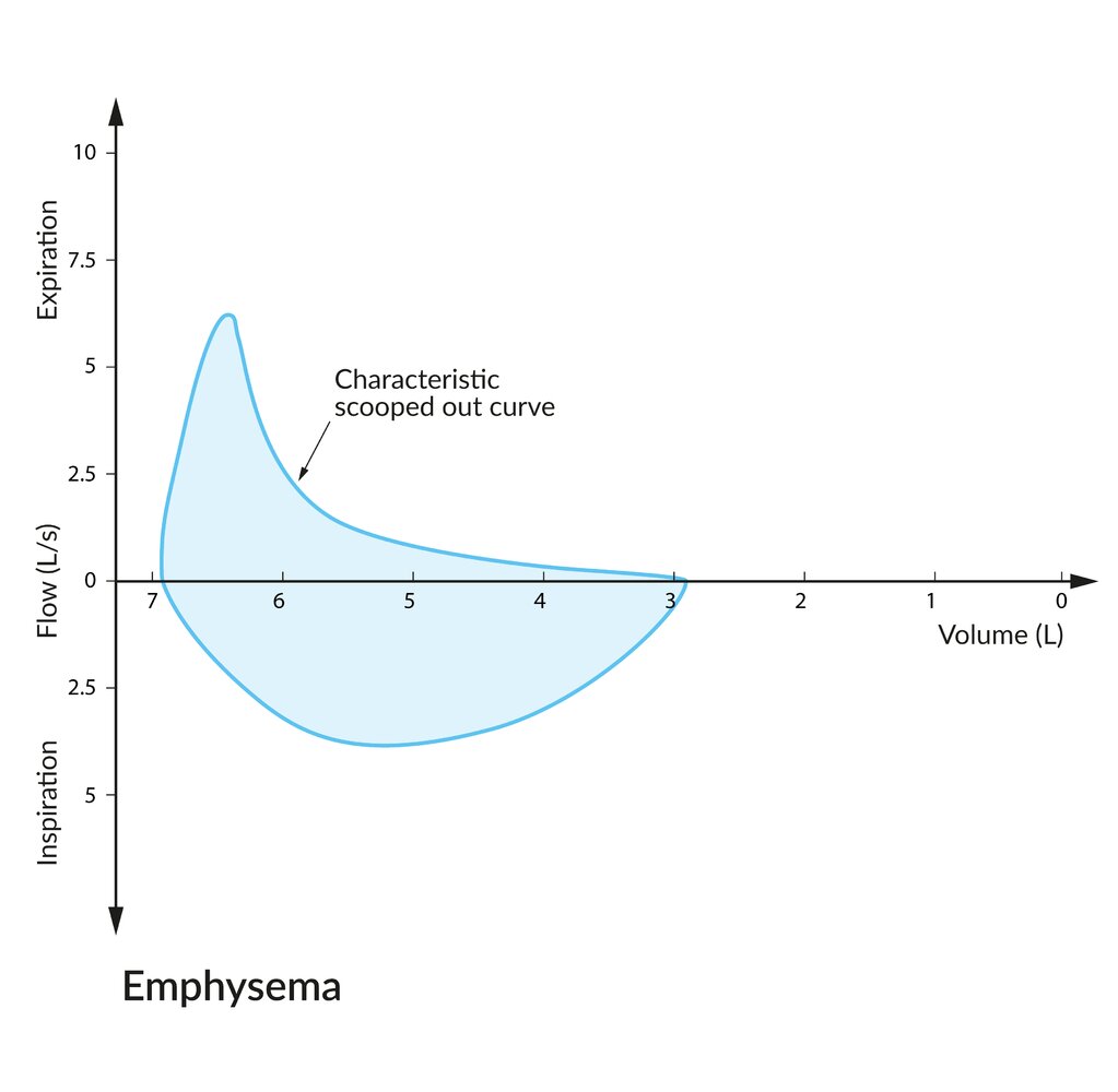Flow-volume loop in emphysema