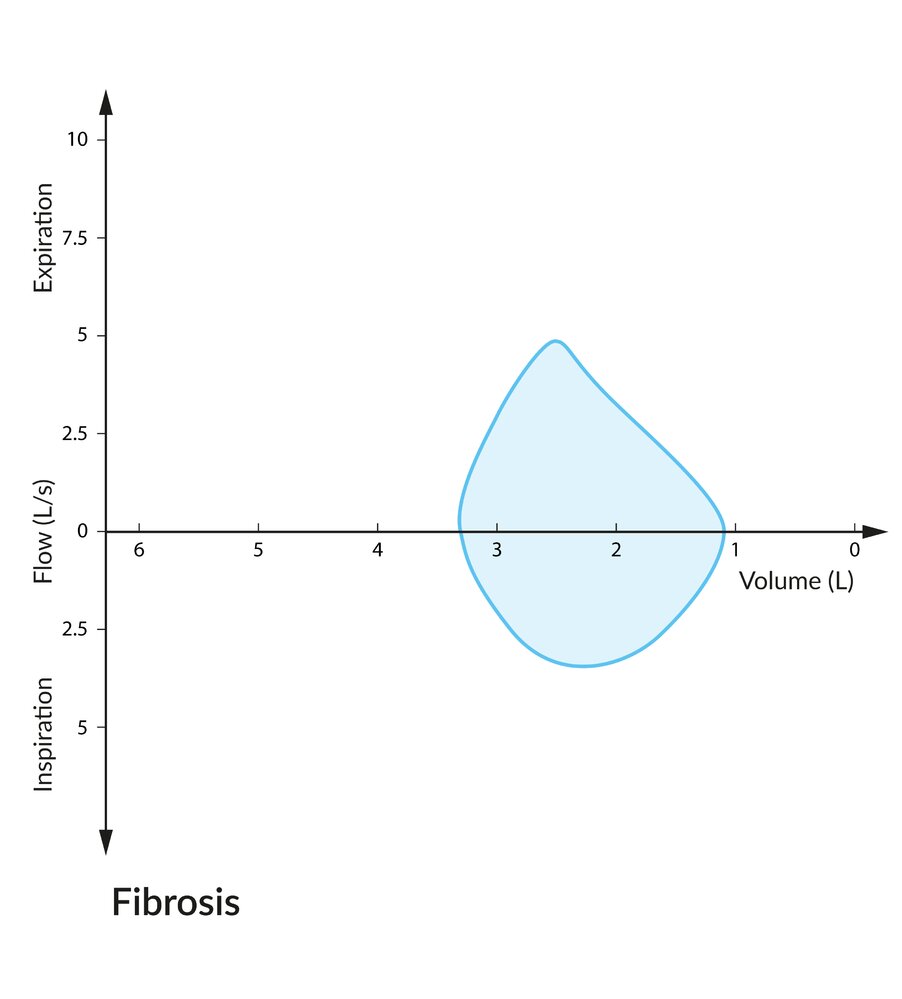 Flow-volume loop in fibrosis