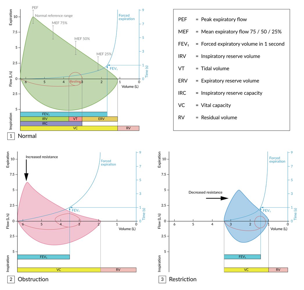 Flow-volume loop in obstructive and restrictive lung diseases