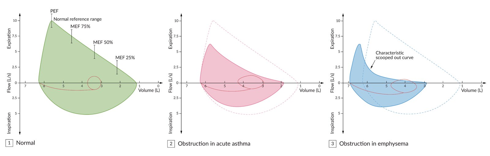 Flow-volume loop in obstructive lung diseases