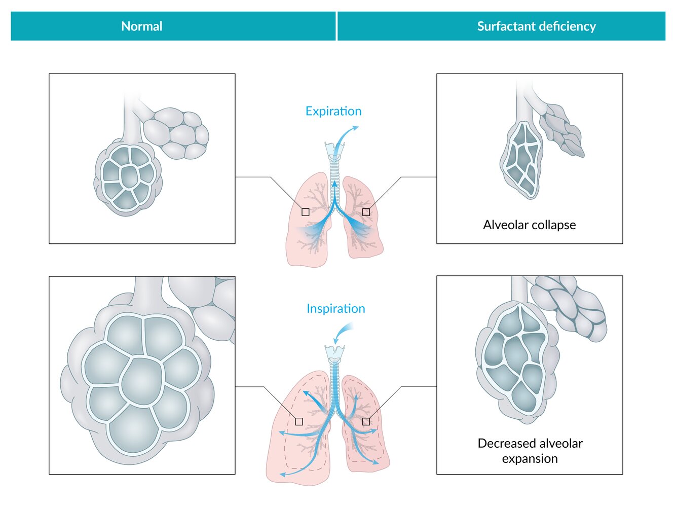 Alveolar collapse in surfactant deficiency