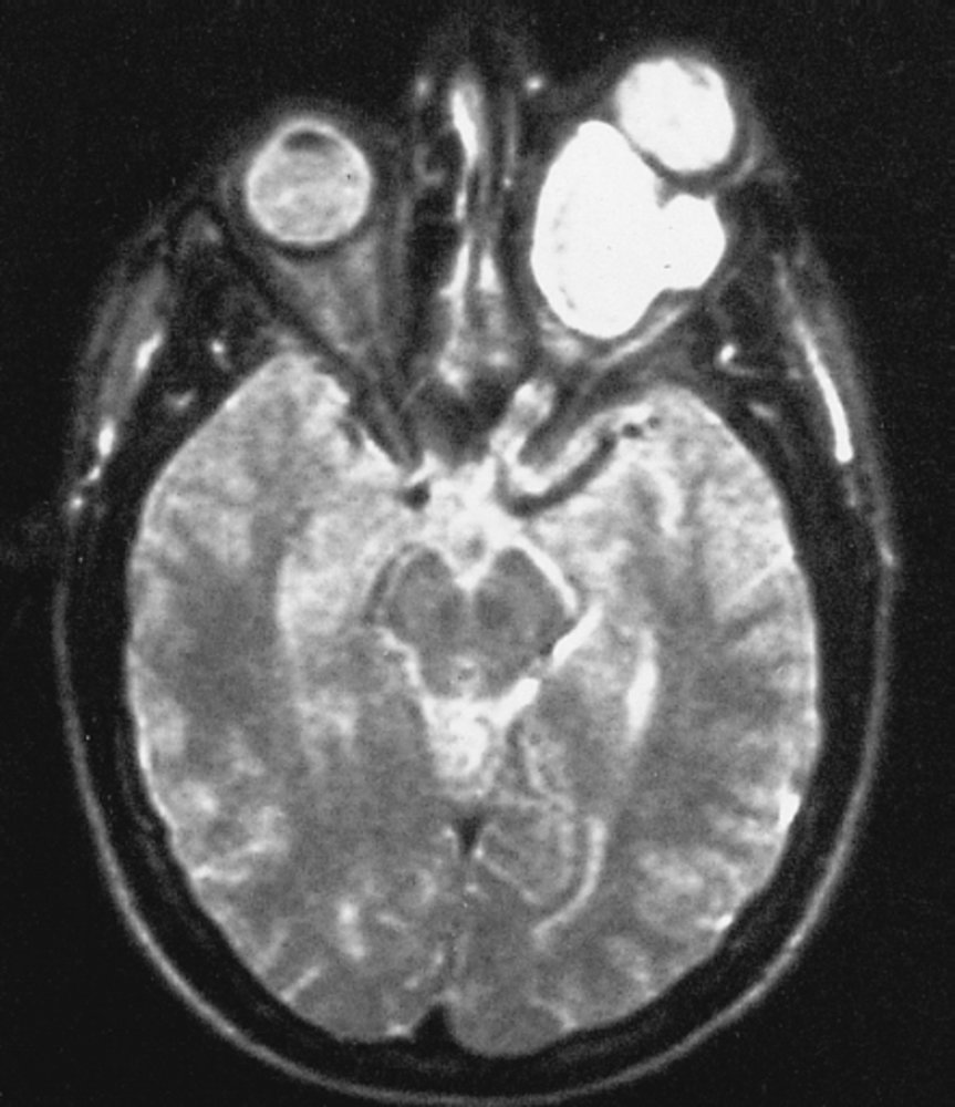 Intraconal orbital mass