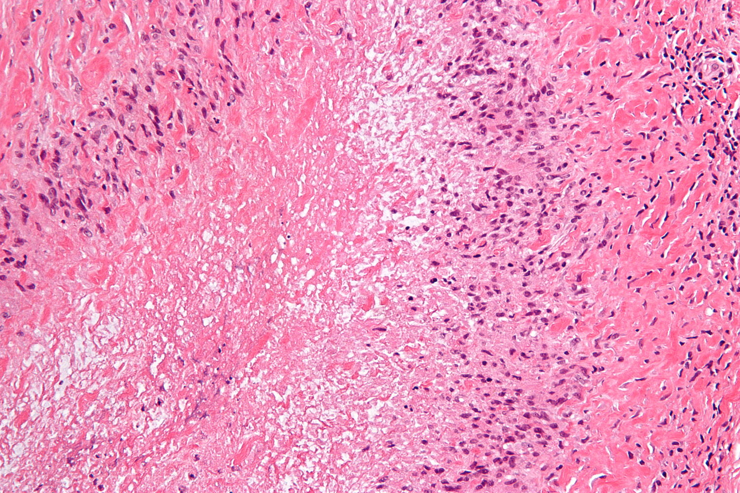 Rheumatoid nodule
