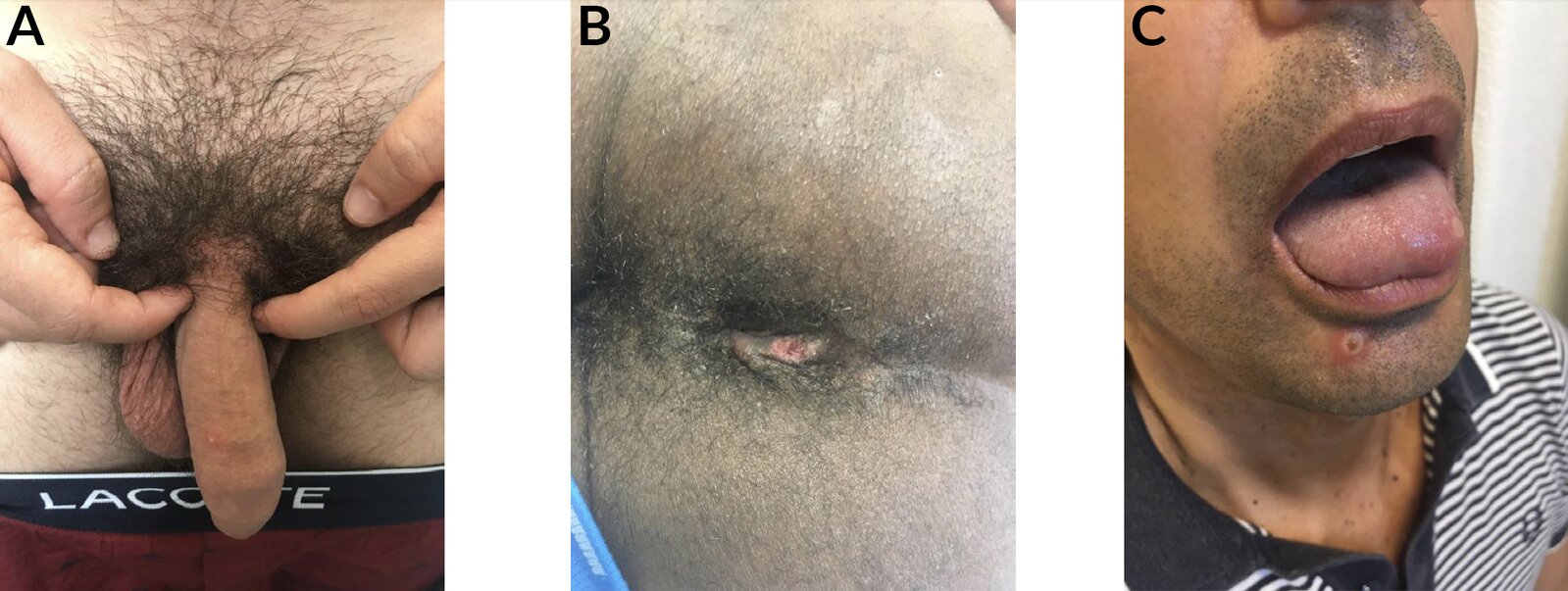 Mpox