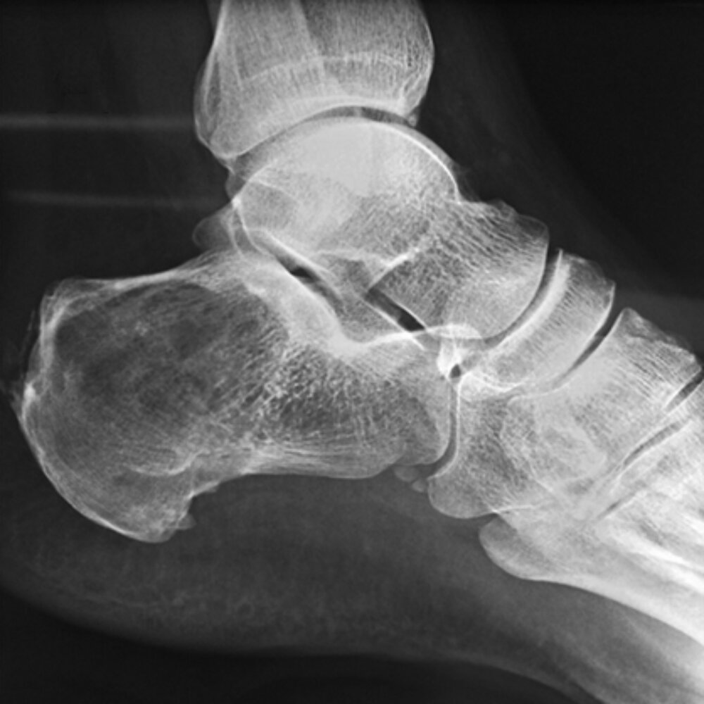 Lytic calcaneal lesion with calcifications