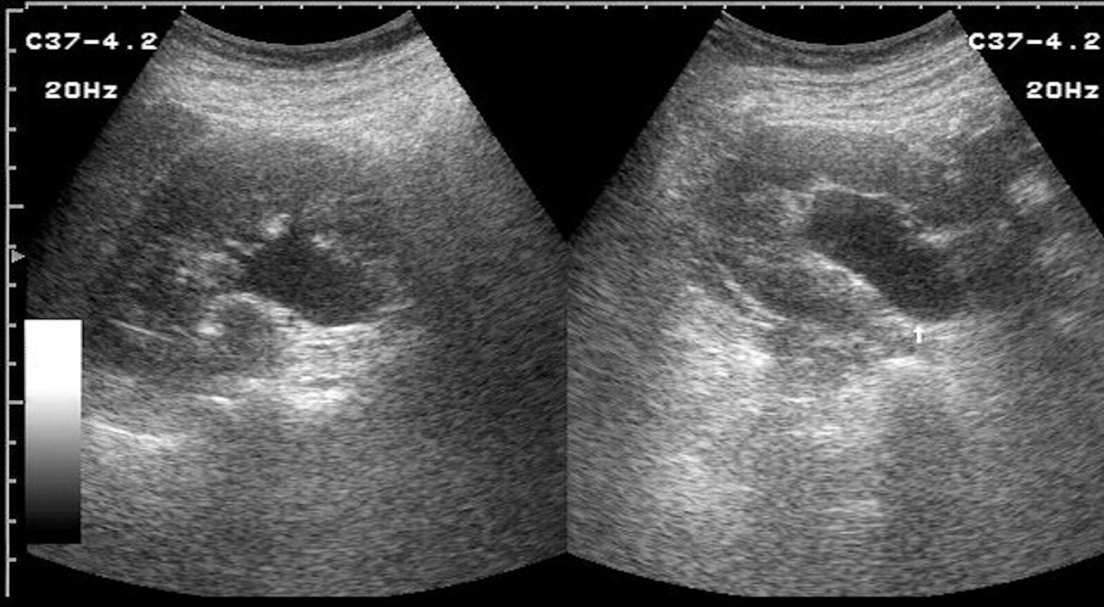 Hydronephrosis (grade I)