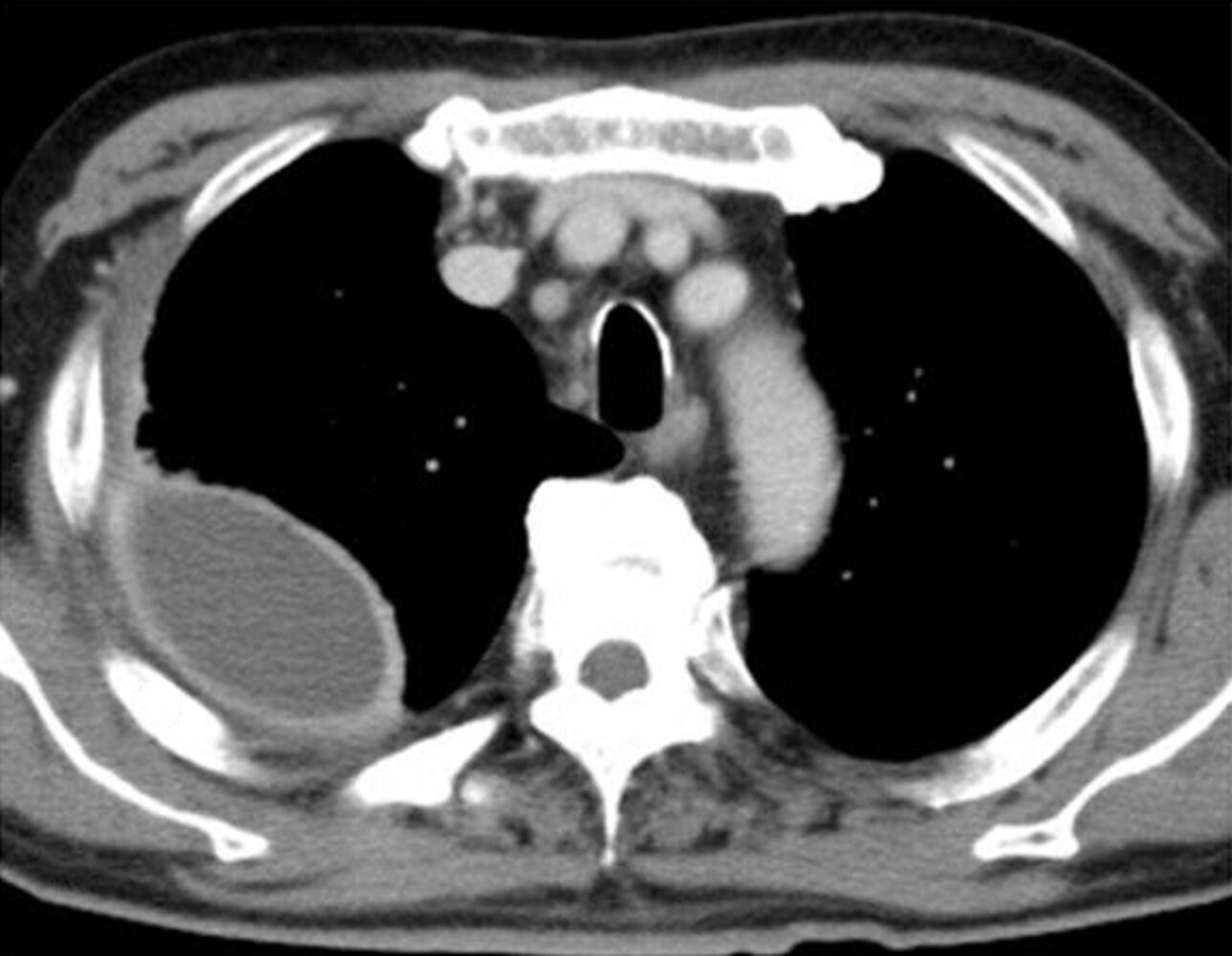 Split-pleura sign