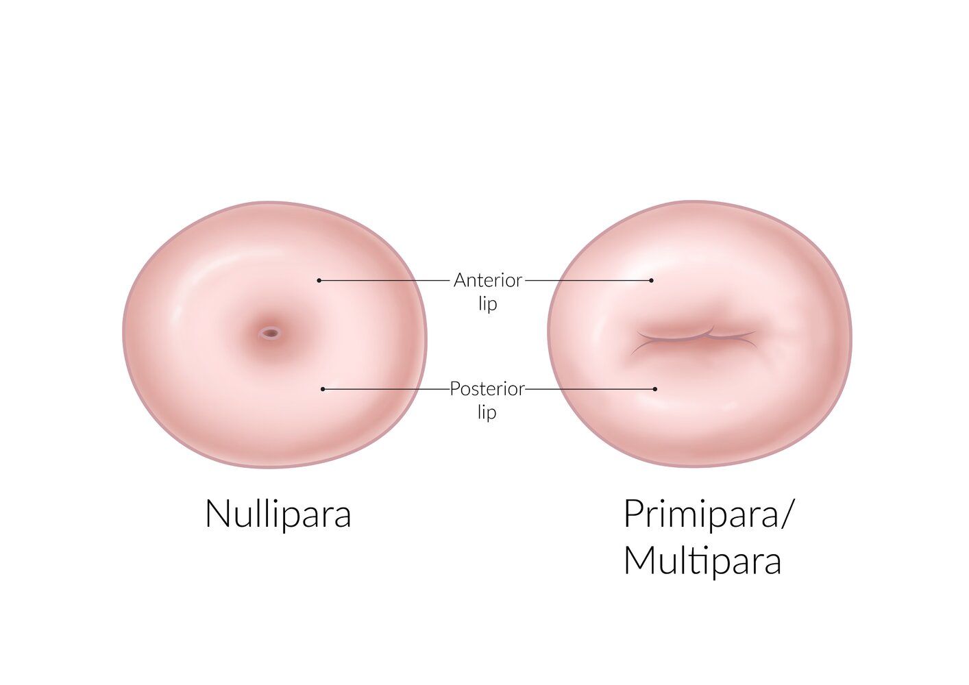 Ectocervix and the external os