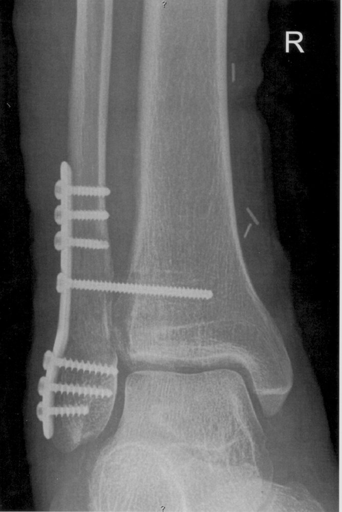 Open reduction-internal fixation of Weber B ankle fracture (1/2)