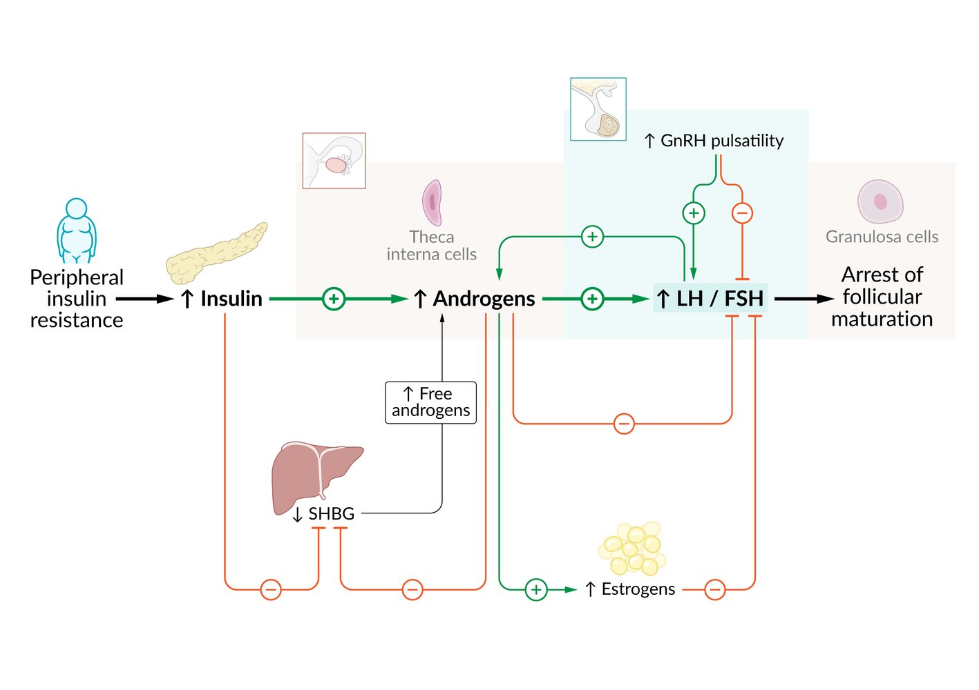 Pathophysiology of polycystic ovary syndrome
