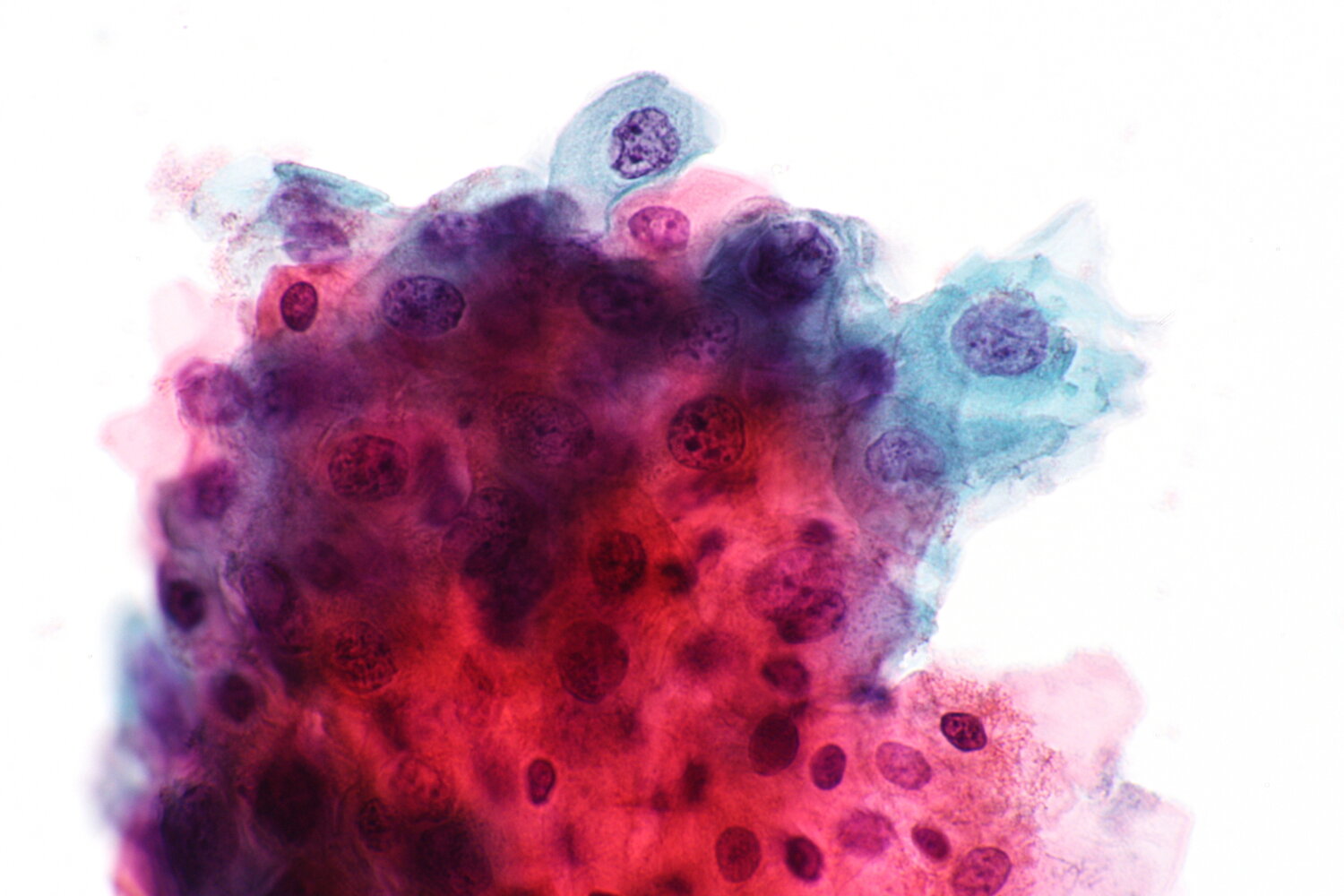 Atypical squamous cells of undetermined significance (ASC-US)
