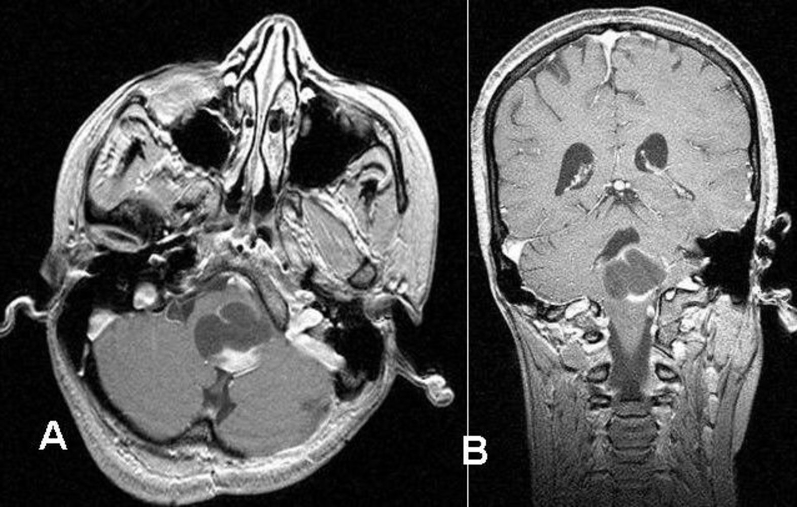 Posterior fossa mass