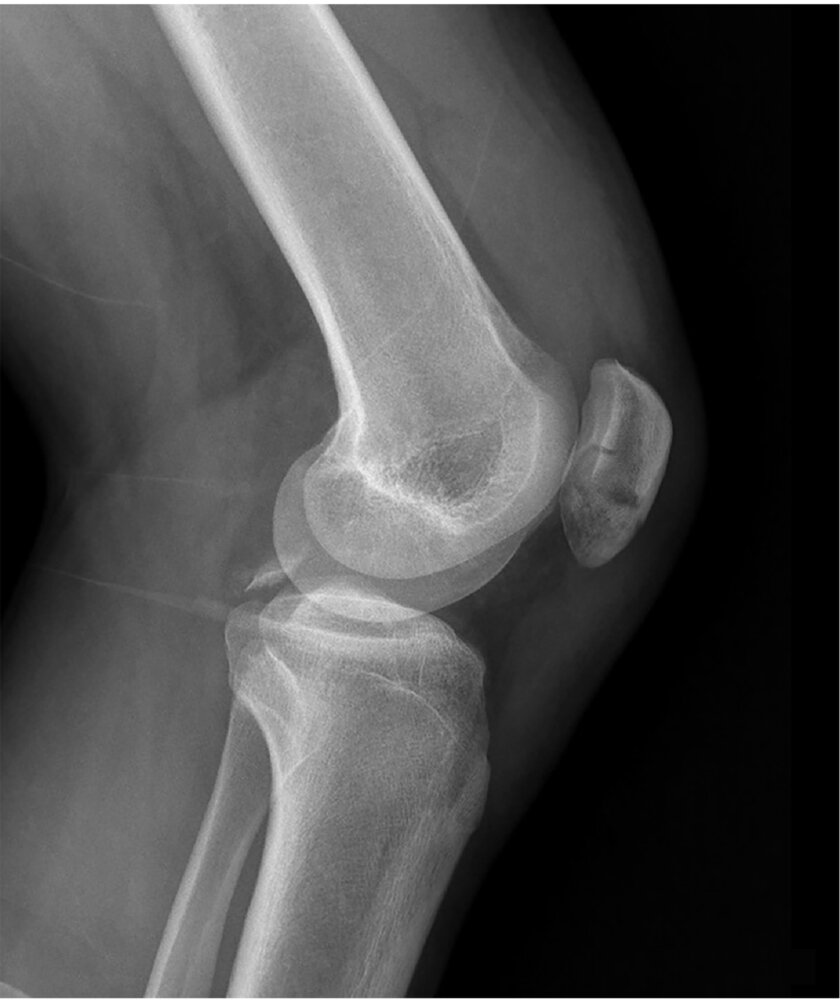Tibial avulsion fracture and patellar fracture with joint effusion (1/2)
