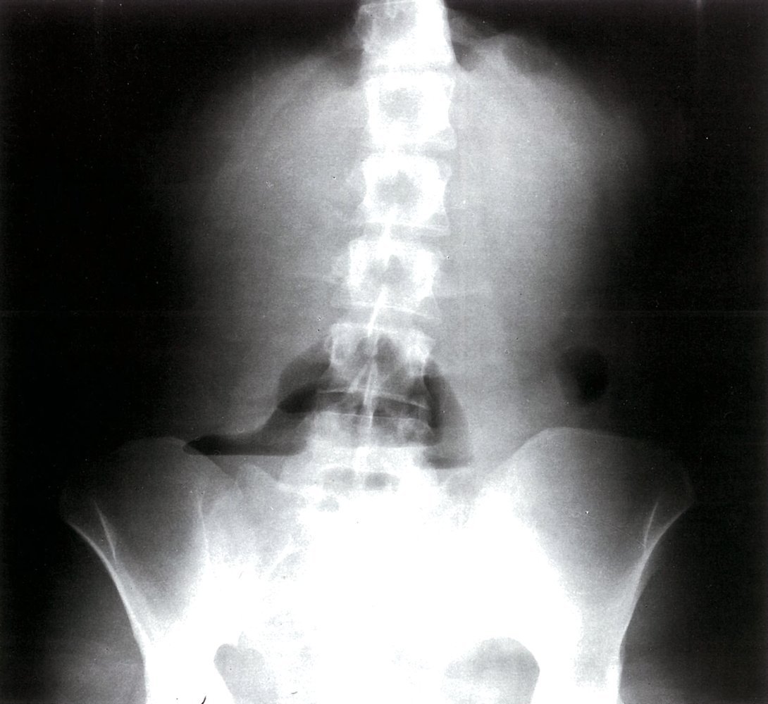 Abdominal air-fluid levels