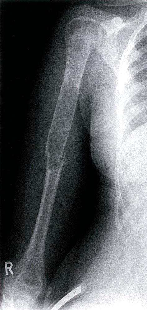 Humeral unicameral bone cyst (UBC) with pathological fracture