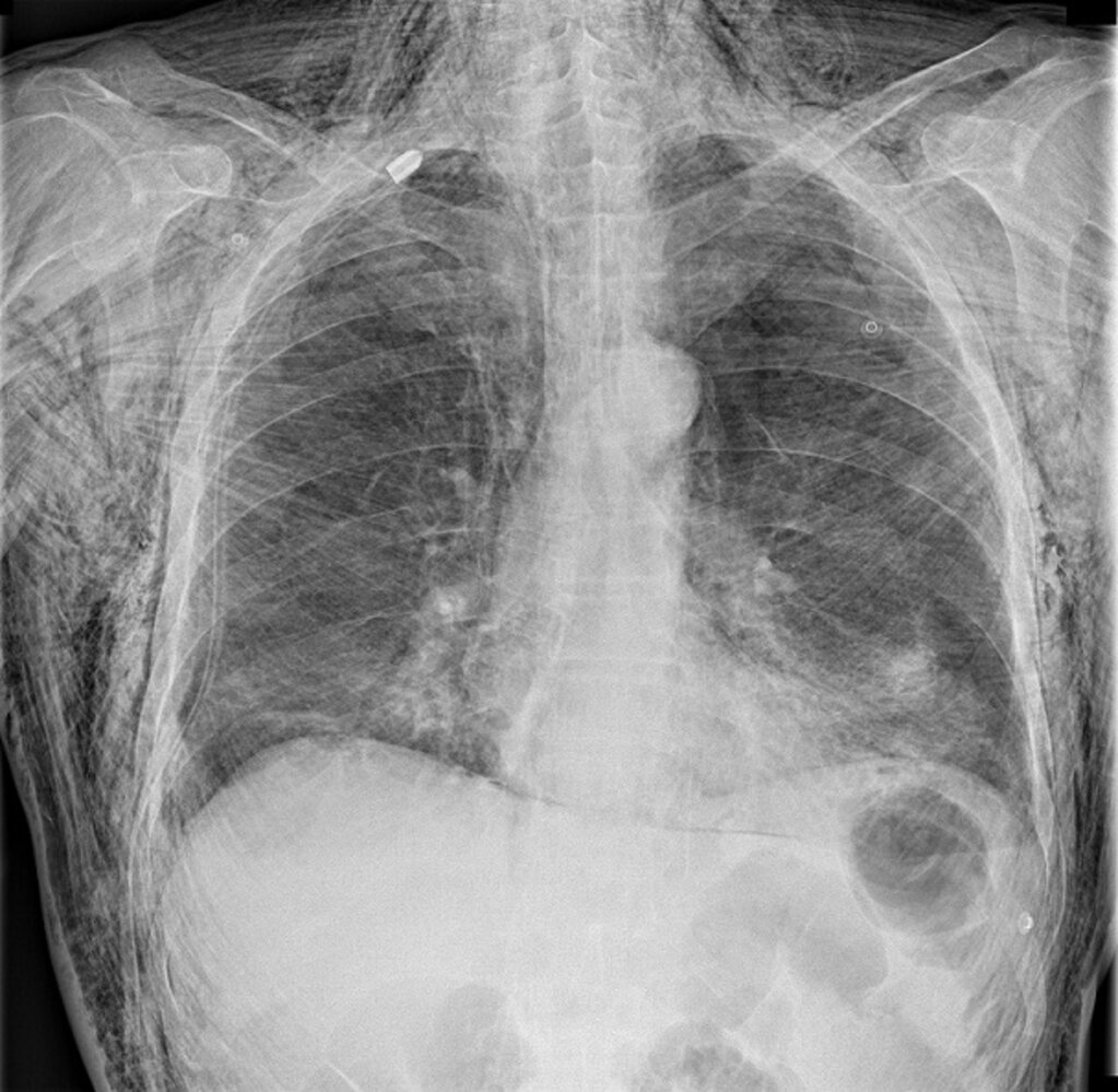 Traumatic pneumothorax and pneumomediastinum with subcutaneous emphysema
