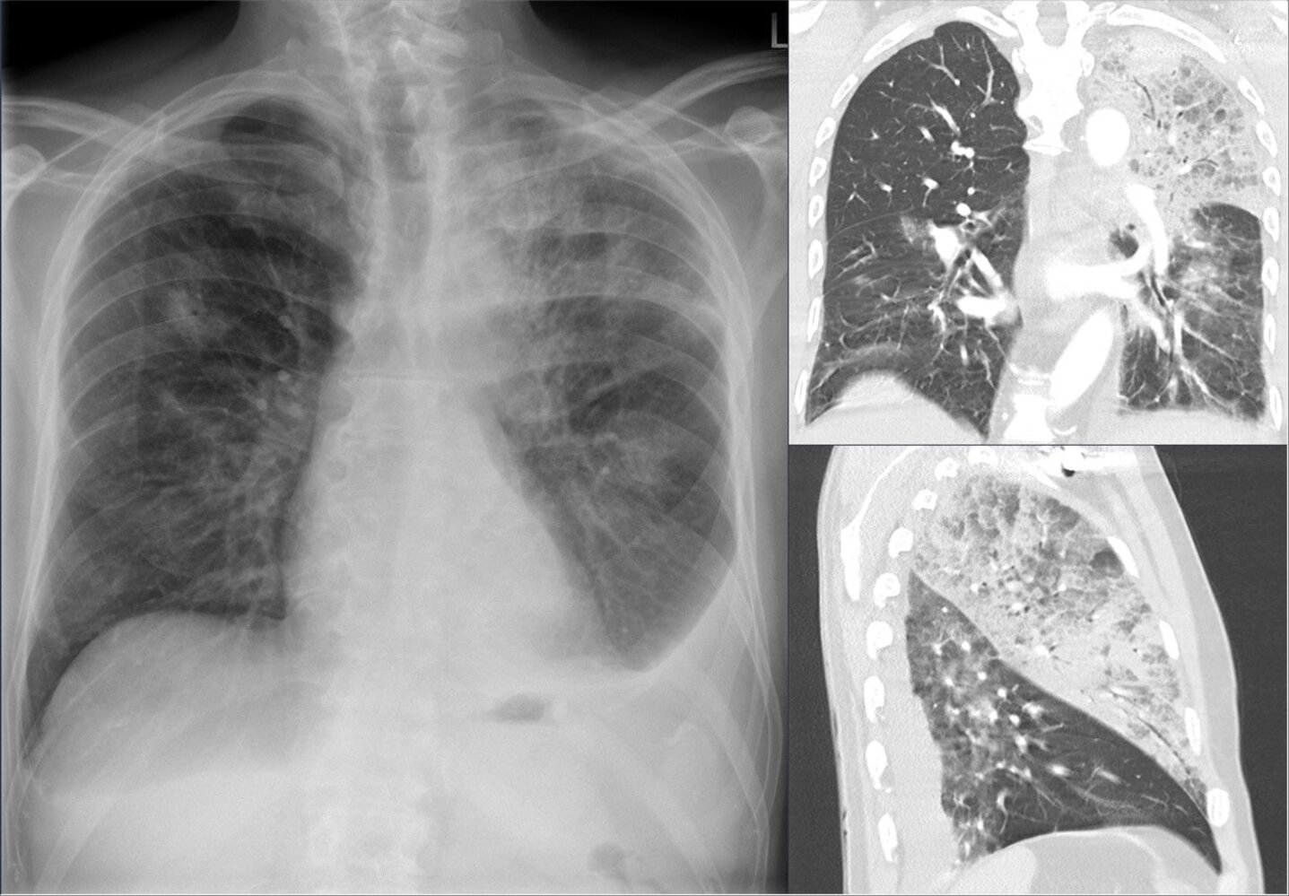Multifocal pneumonia with pleural effusions
