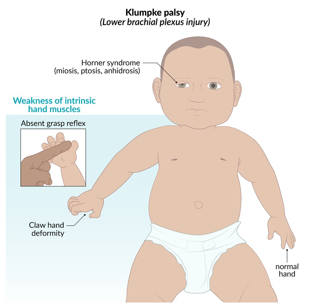 Klumpke palsy