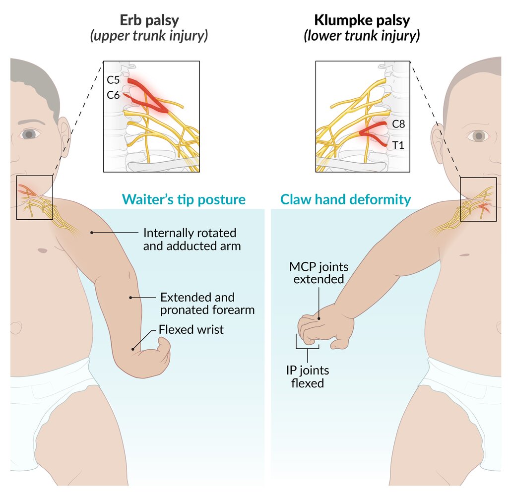 Brachial plexus injuries: Erb palsy and Klumpke palsy