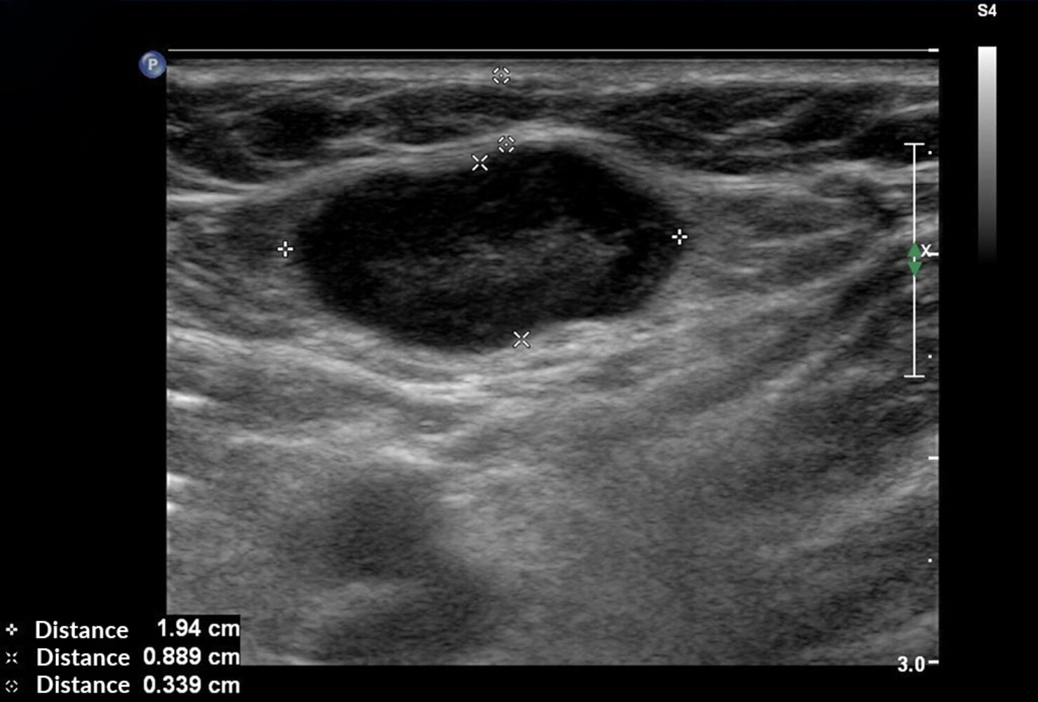 Reactive inguinal lymph node
