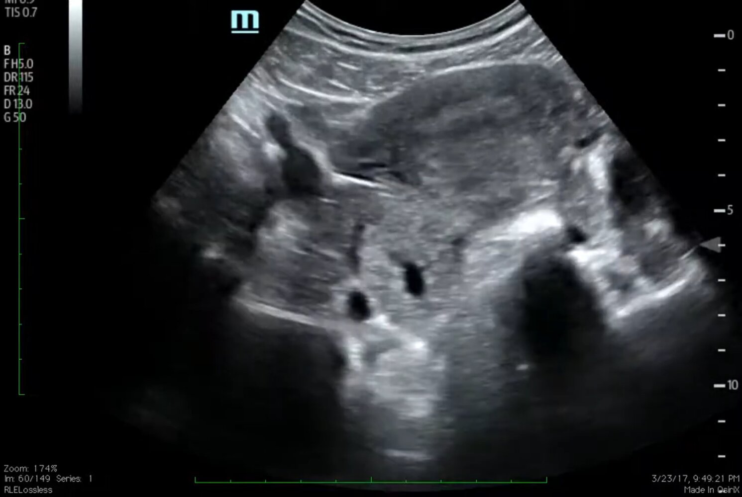 Ectopic pregnancy