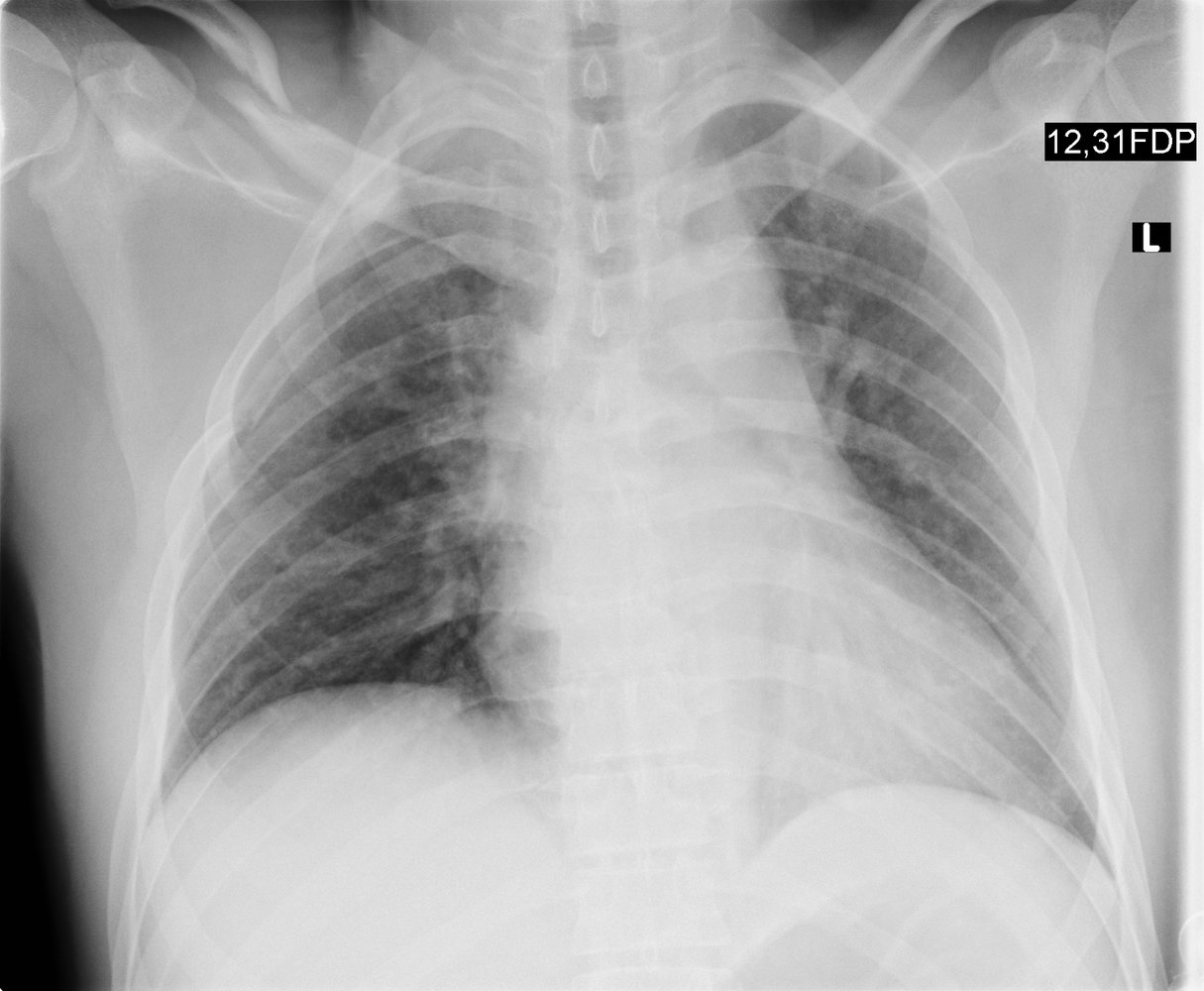 Clavicle and rib fractures