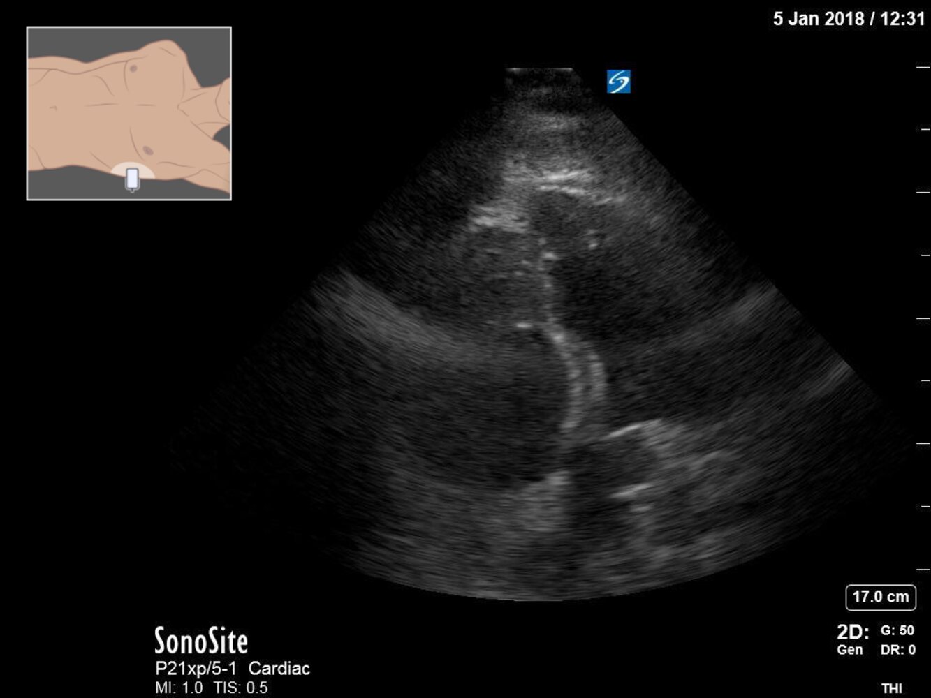 Right ventricular dilatation