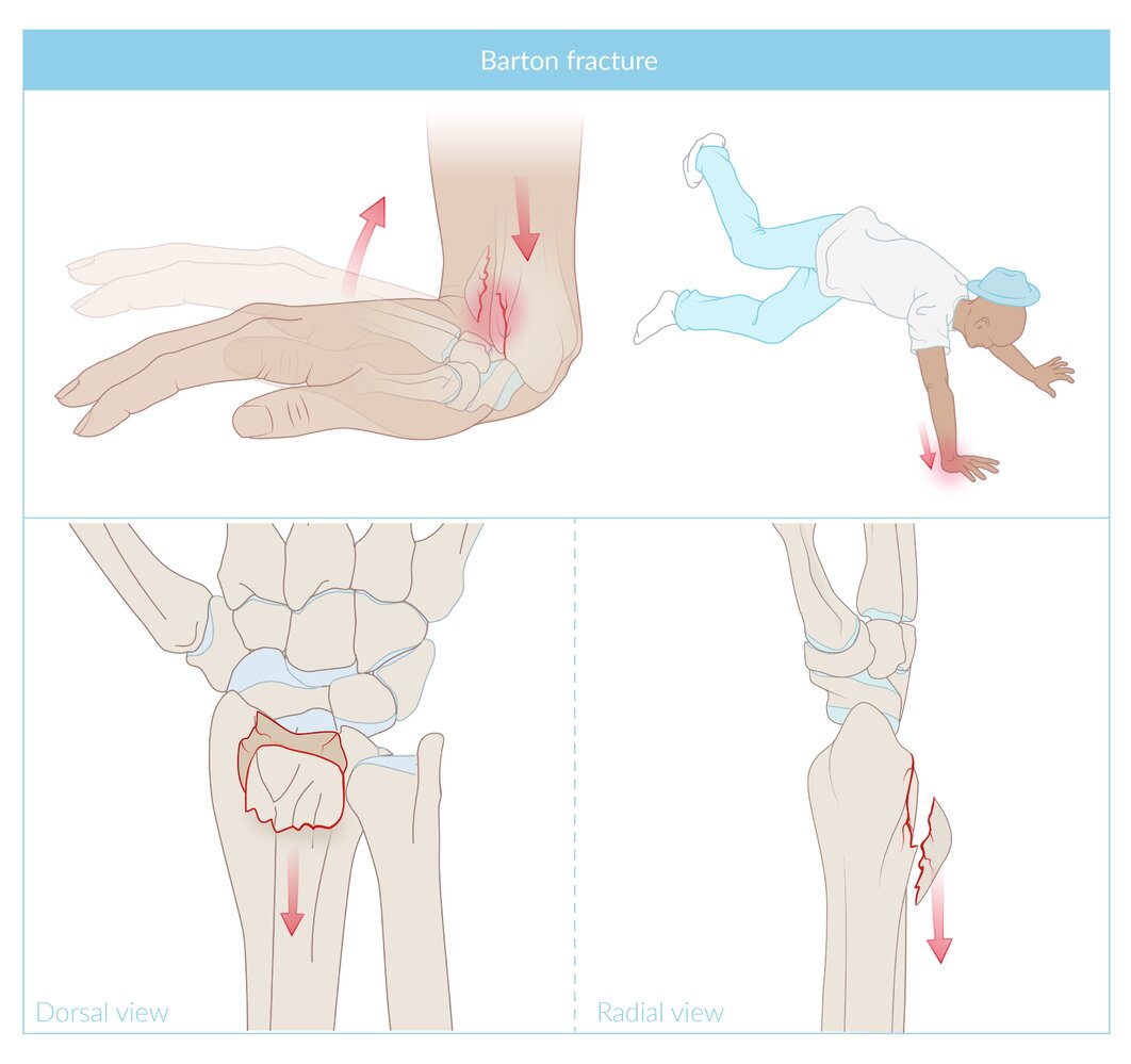 Barton fracture