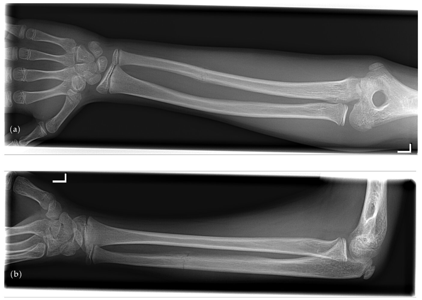 Parry fracture