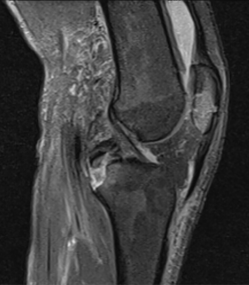 Tibial avulsion fracture and patellar fracture with joint effusion (2/2)