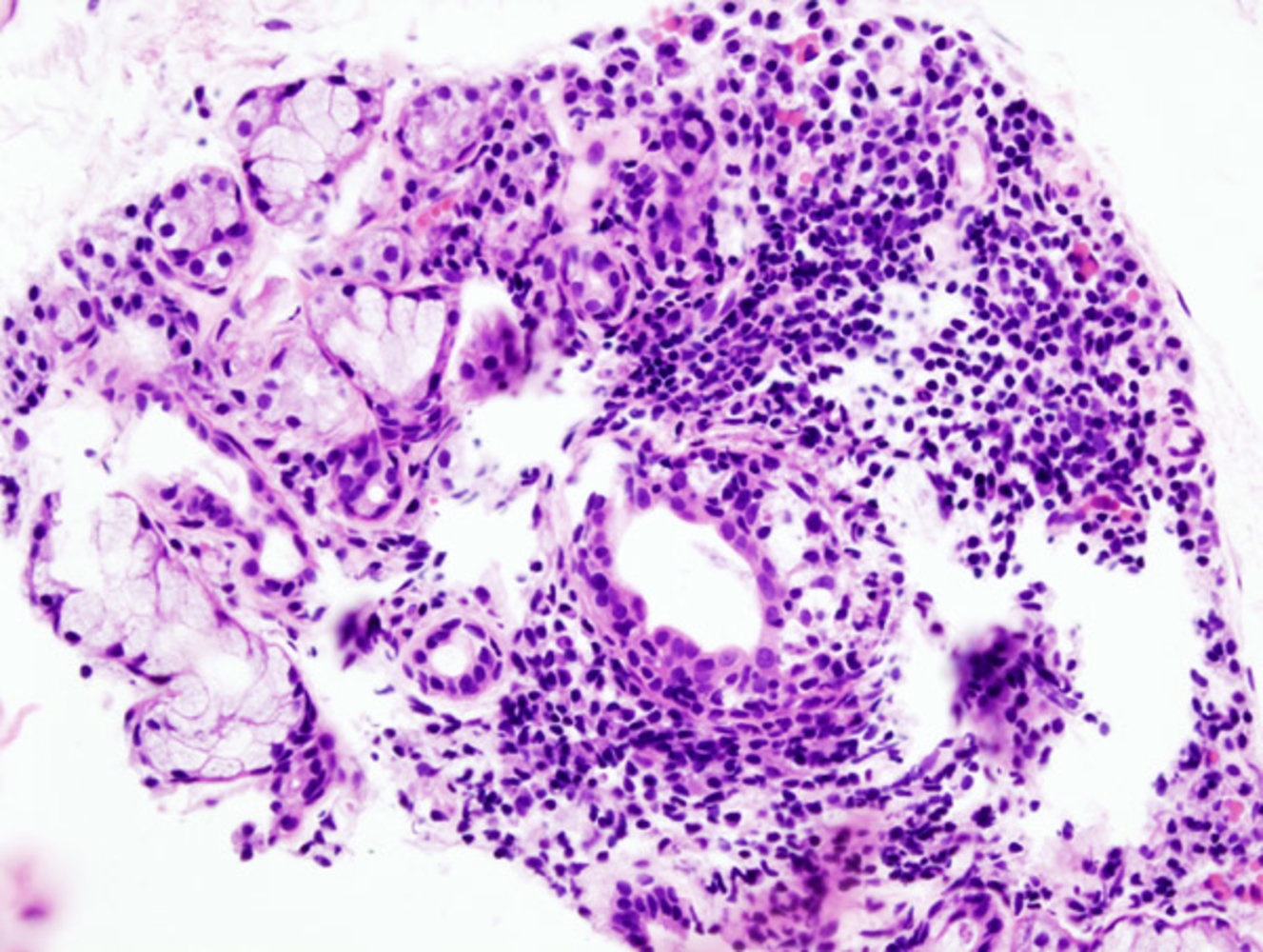 Chronic sialadenitis in Sjogren syndrome