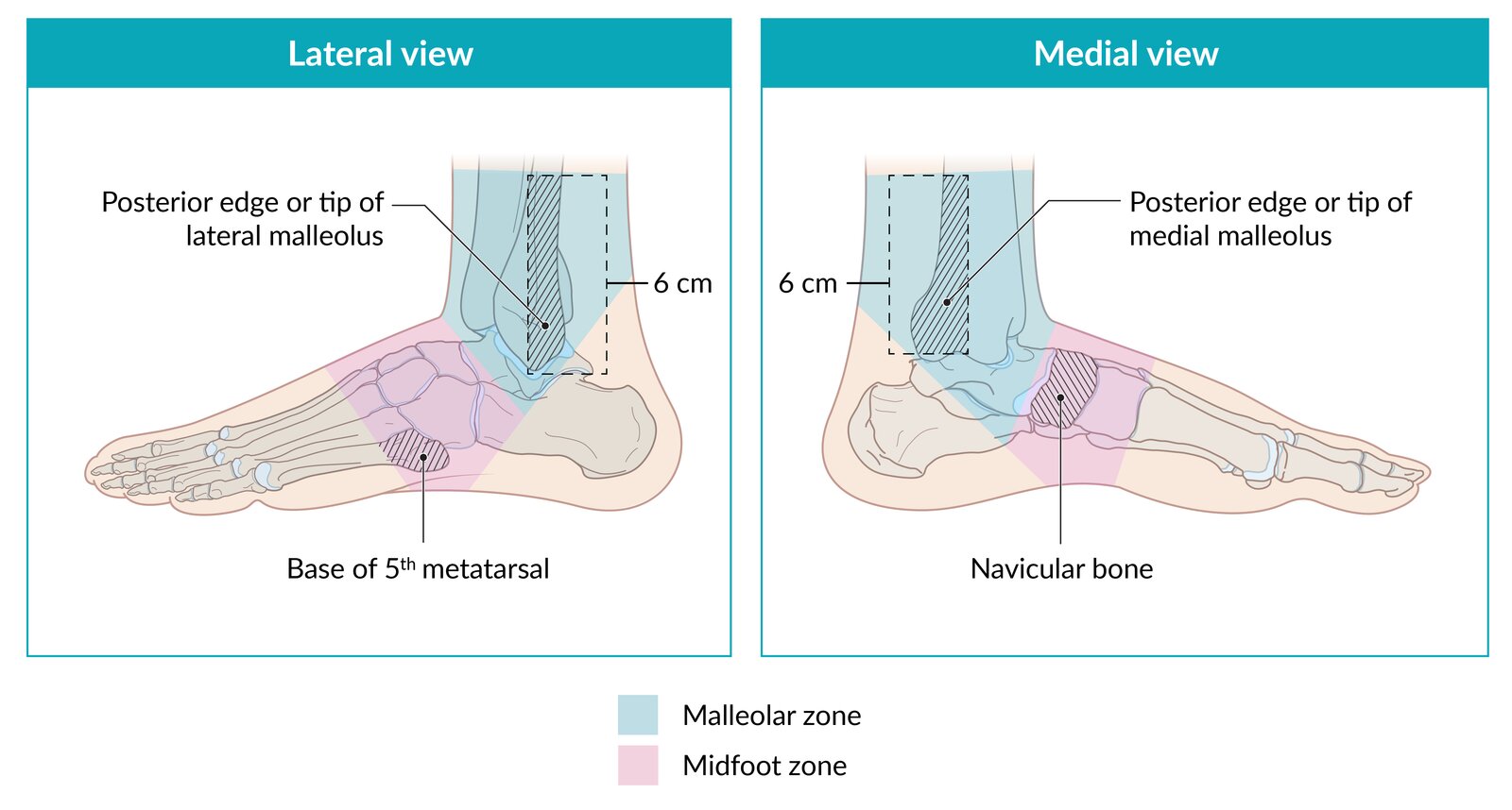 Ottawa ankle and foot rules