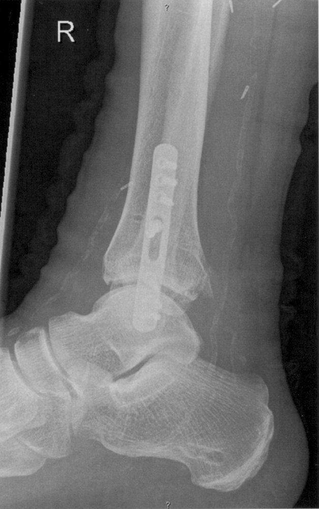 Open reduction-internal fixation of Weber B ankle fracture  (2/2)