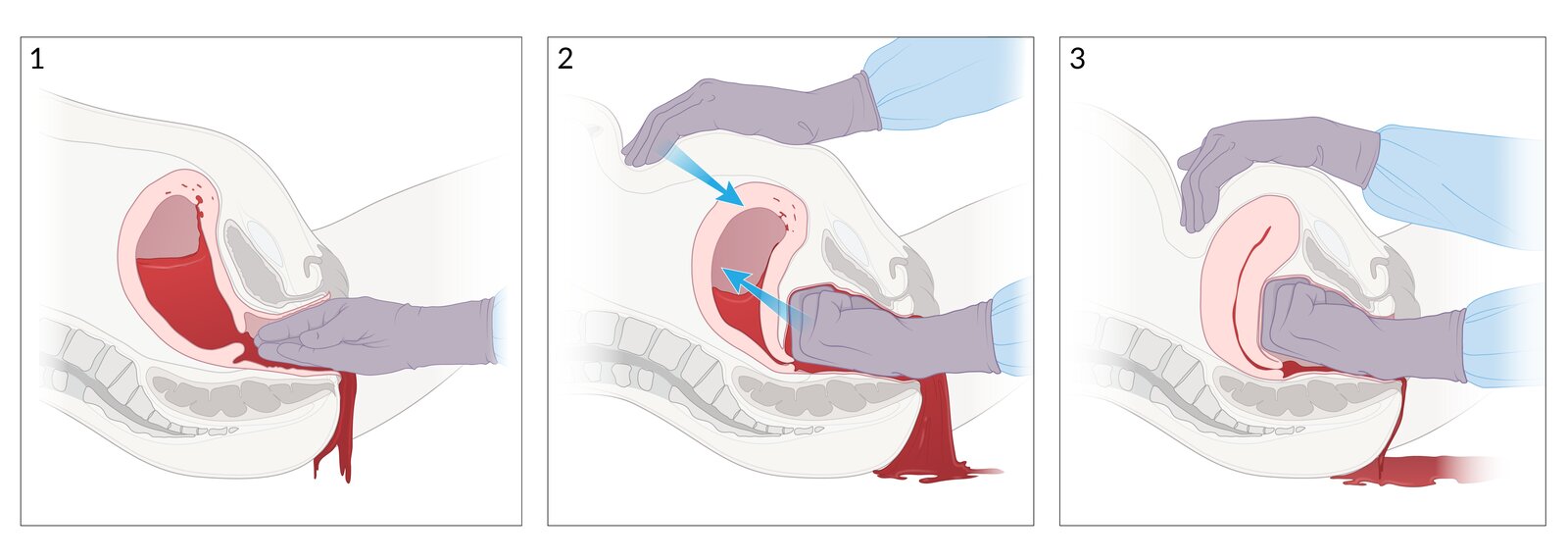 Bimanual uterine massage
