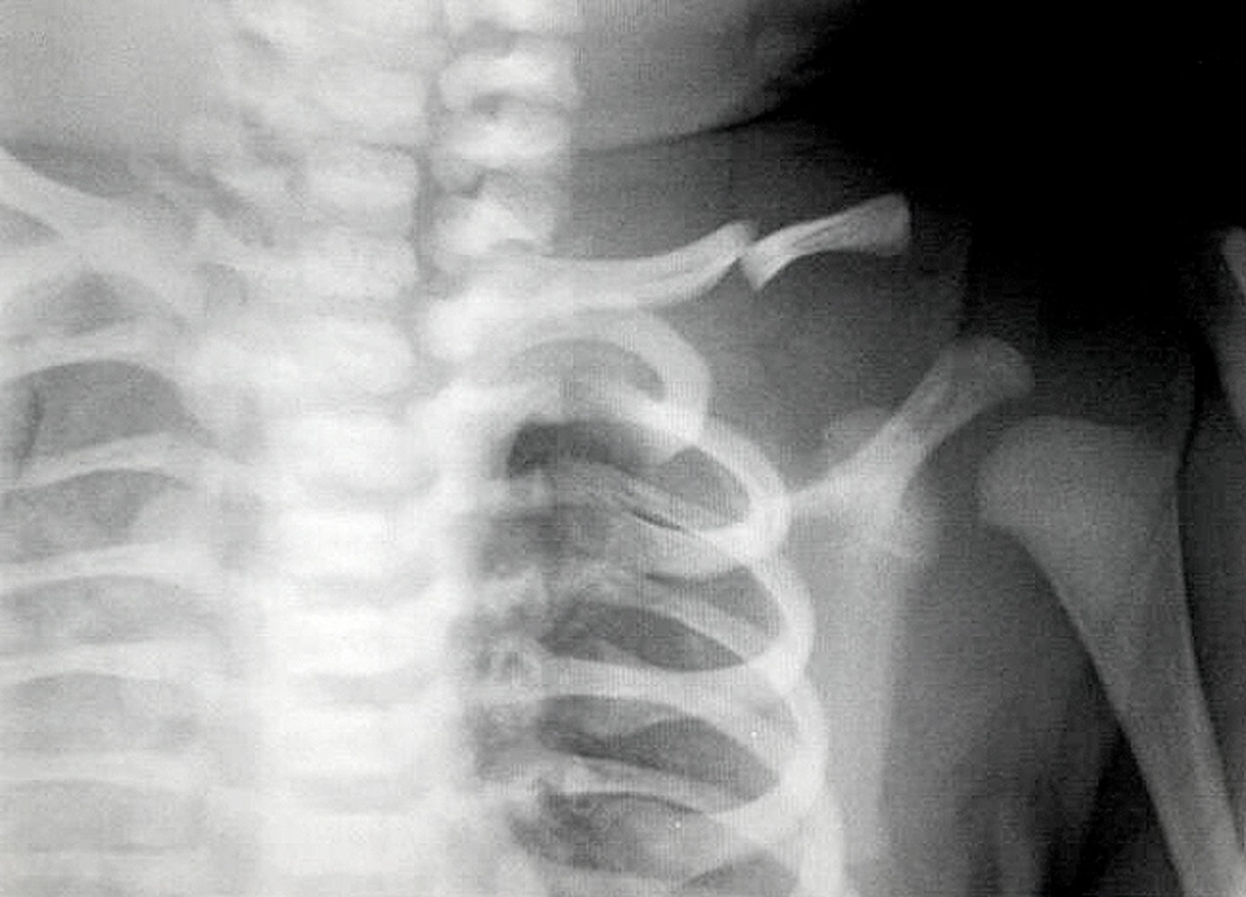 Neonatal clavicle fracture
