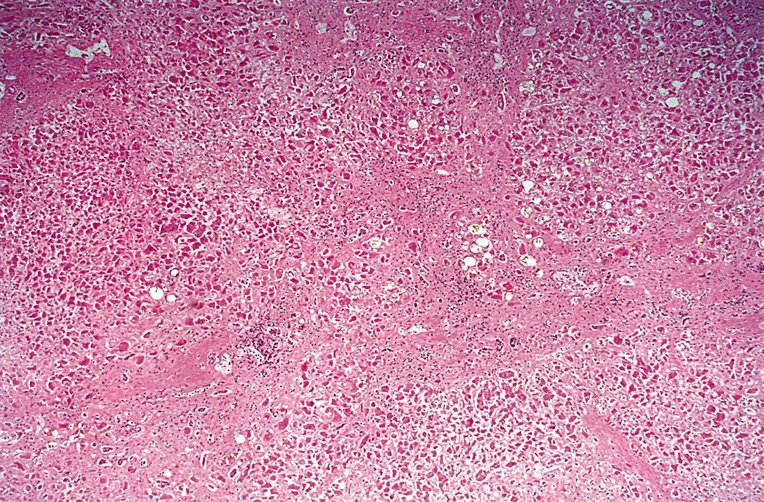 Liver cirrhosis in chronic hepatitis B
