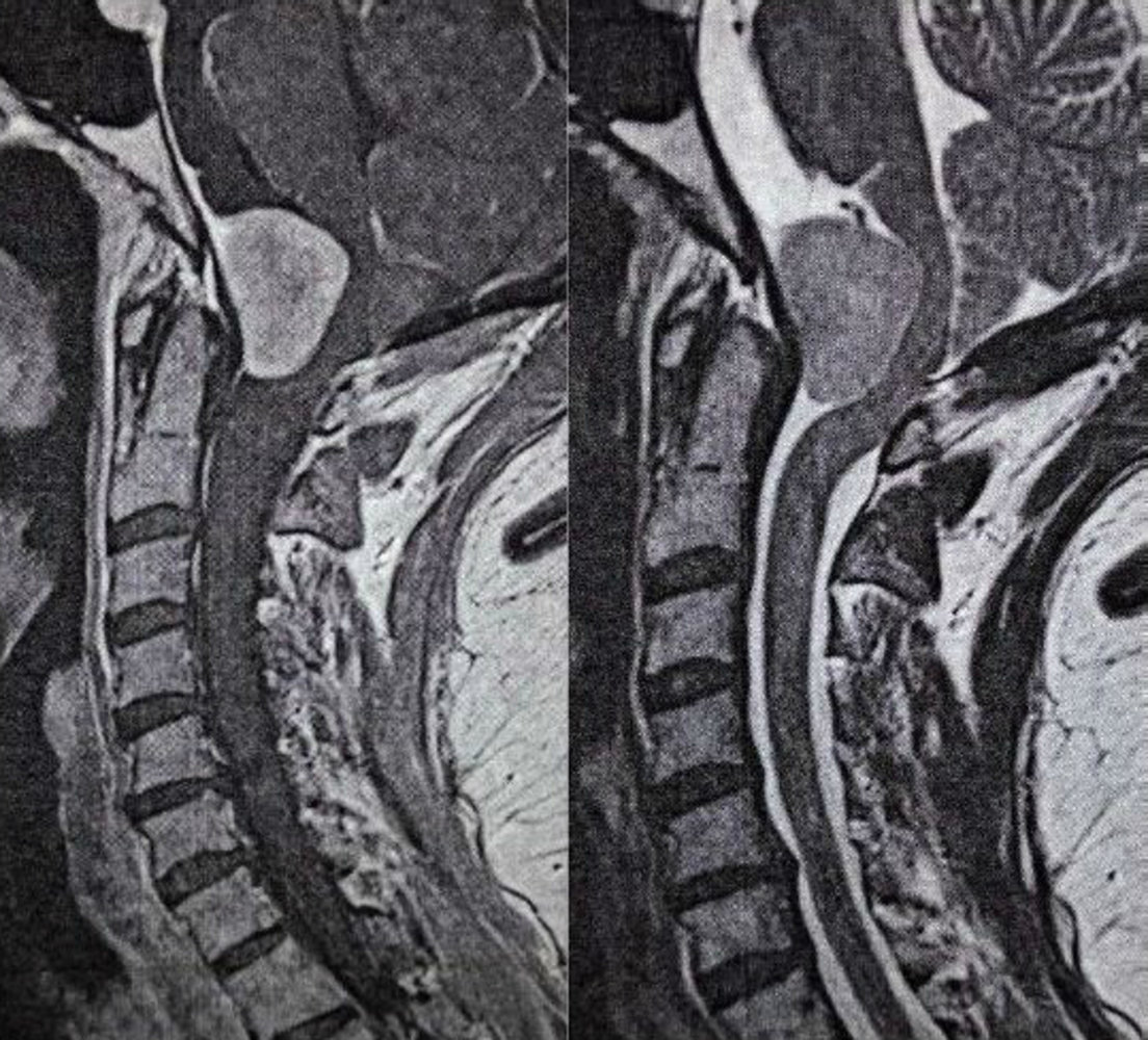 Foramen magnum meningioma