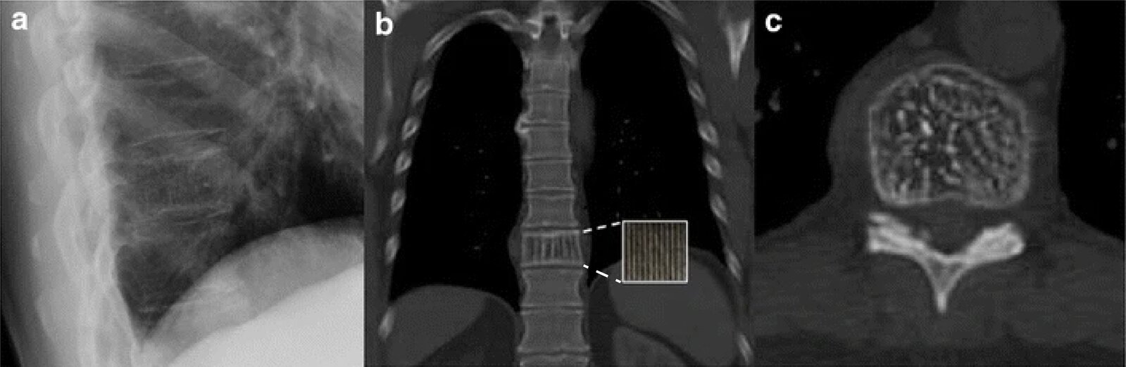 Thoracic vertebral hemangioma