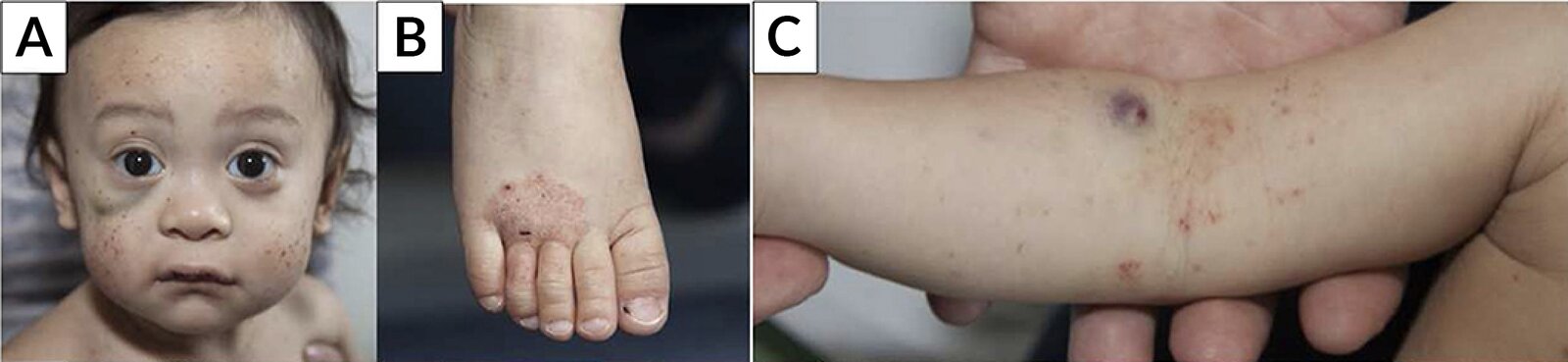 Wiskott-Aldrich syndrome