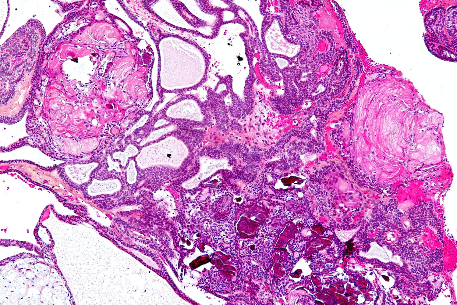 Adamantinomatous craniopharyngioma